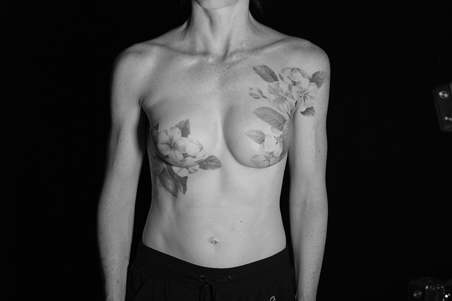 mastectomy photo